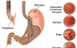 Як роблять гастроскопію шлунка