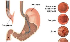 How to do gastroscopy of the stomach